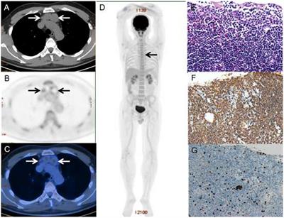 Thymic Extranodal Marginal-Zone Lymphoma of Mucosa-Associated Lymphoid Tissue: Pathological Features, 18F-FDG PET/CT Findings and Prognosis in 12 Cases